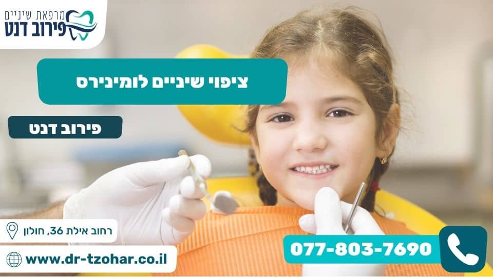 ציפוי שיניים לומינירס