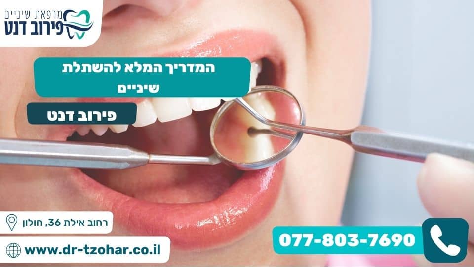המדריך המלא להשתלת שיניים