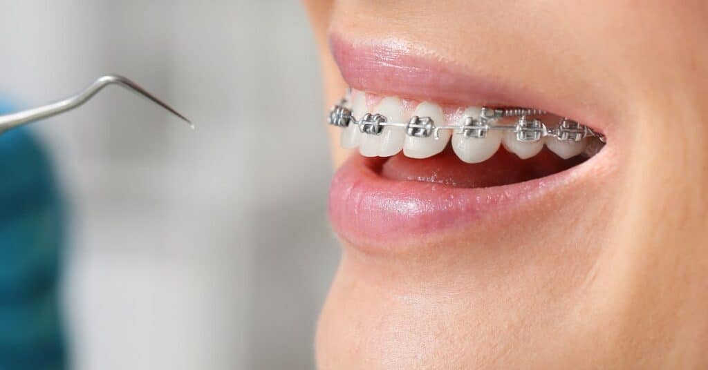 גשר אורתודנטי מתכתי (Braces)